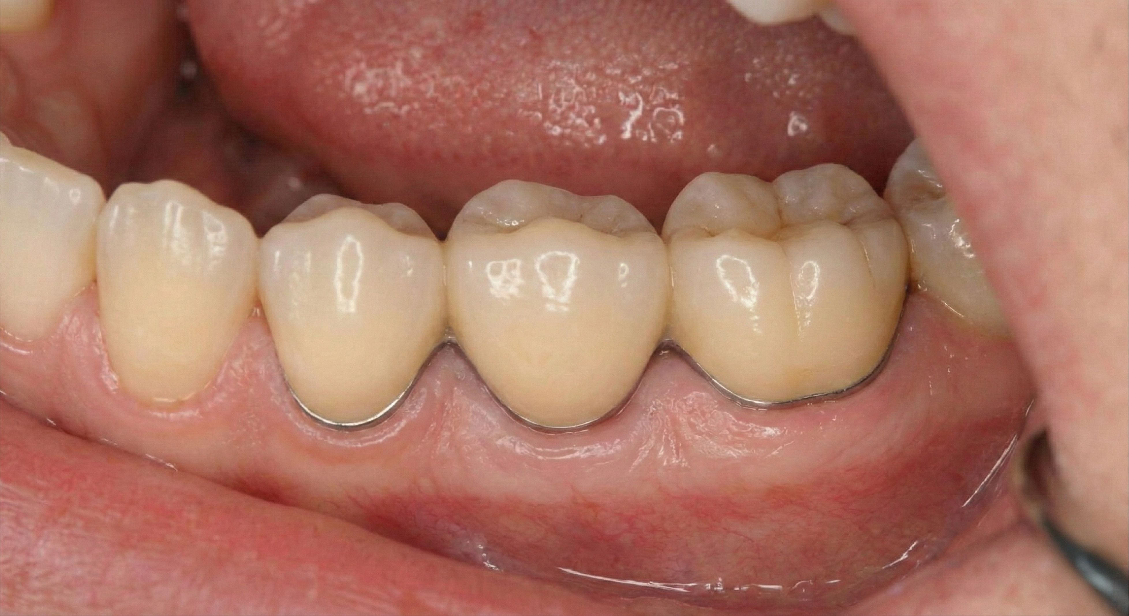 After — PFM Bridge